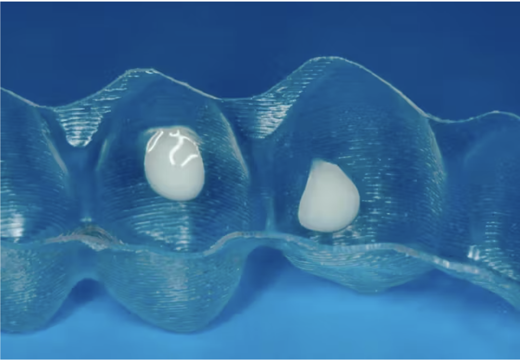 Vì sao attachment quyết định thành công trong điều trị bằng khay trong suốt?